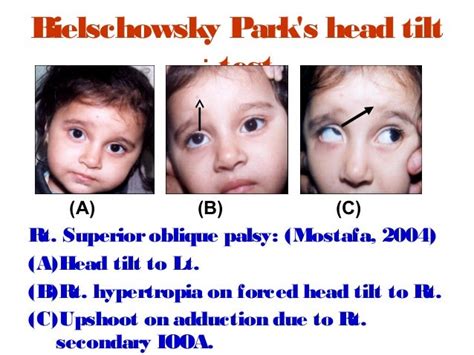 Superior oblique palsy