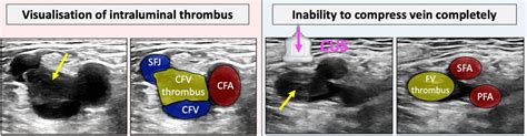 Acute Dvt Ultrasound