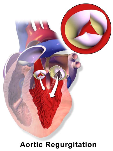 Aortic Valve Regurgitation Causes, Symptoms, Diagnosis and Treatment ...