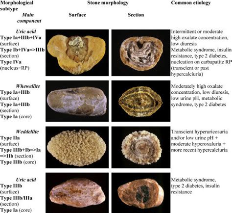 Main relations between mixed types of calcium oxalate–uric acid stones ...