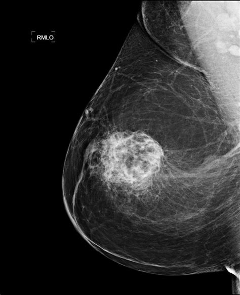 Image IQ: 45-year-old Female, Routine Screening Mammogram Abnormality ...