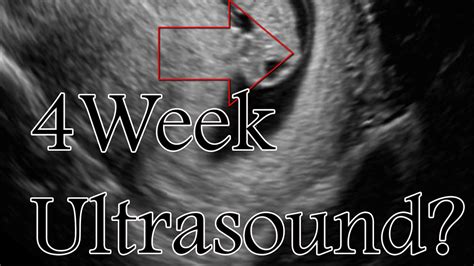 Weeks Pregnant Early Ultrasound And Ectopic Pregnancy, 50% OFF