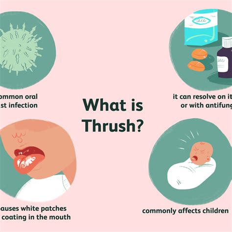 What causes oral thrush | Oral thrush Disease Reference Guide. 2020-09-29