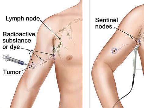 Lymph Node Surgery in Melanoma - NCI