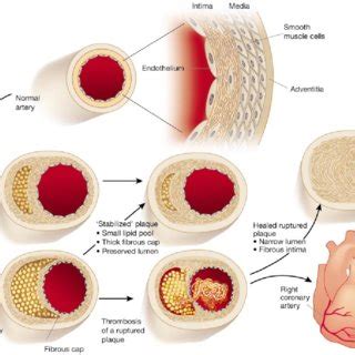 Abdominopelvic Atherosclerosis