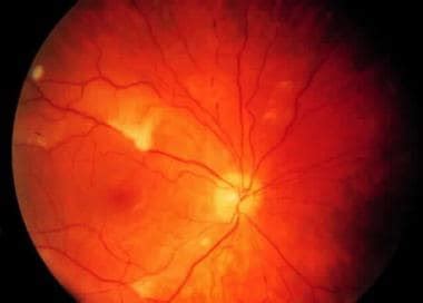 Purtscher Retinopathy and Purtscher-like Retinopathy Clinical ...