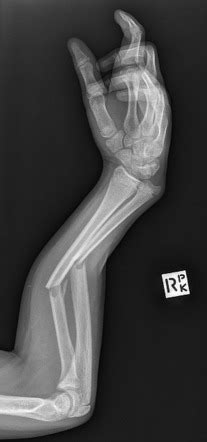 Midshaft radius and ulnar fractures | Radiology Case | Radiopaedia.org