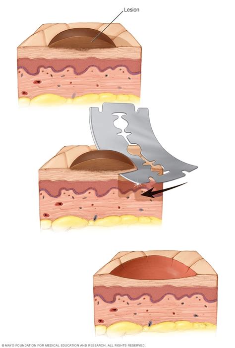 Shave biopsy - Mayo Clinic