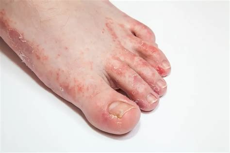 Foot rash | causes, symptoms, home remedies & treatment, pictures