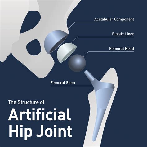 Partial Hip Replacement vs. Total Hip Replacement - USA Spine & Ortho