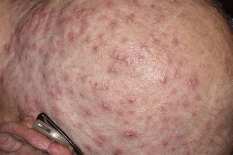 Scalp folliculitis - Stock Image - C047/2803 - Science Photo Library