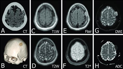 An epidermoid cyst has been confirmed on pathological anatomy in a ...