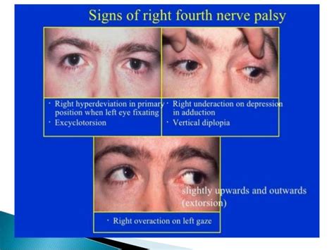 Cranial Nerve Palsy Mri