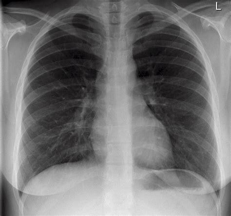 normal chest x-ray | ha! no radon-induced lung cancer as of … | Flickr