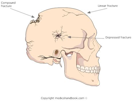 Types Of Skull Fracture - Fracture Treatment