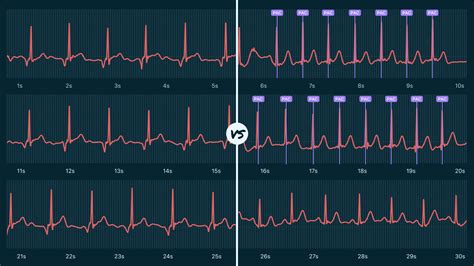 Junctional Rhythm Vs. Supraventricular Tachycardia (Non-Sustained) on ...