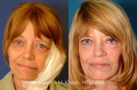 New York Facial Paralysis Treatment | Maurice M. Khosh MD, FACS