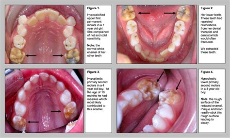 Enamel Hypoplasia