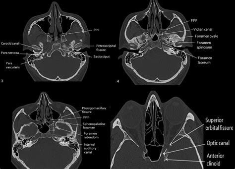 Axial Skull Anatomy