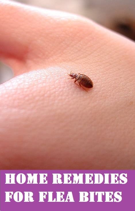 How to Treat Flea Bites in Humans; 7 Tried & Tested Home Remedies