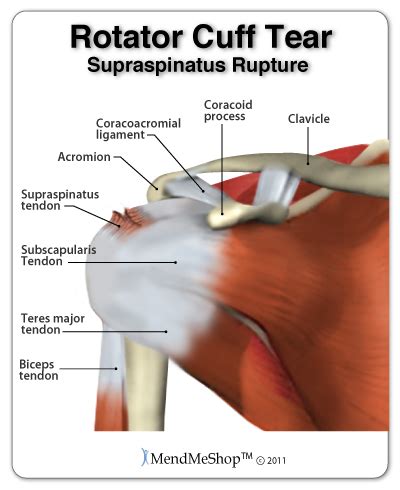 Physical Therapy for Rotator Cuff Injuries - Best Physical Therapist ...