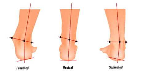 Supination (Foot Biomechanics) Explained - Types, Causes & Treatment