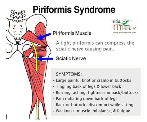 Piriformis Stretch, Sciatica Exercises, Sciatic Pain, Sciatic Nerve ...