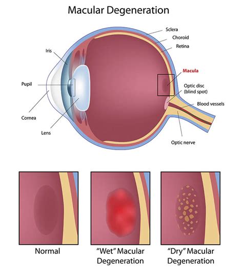 Retina Boston | Macular Degeneration Boston | NEEC