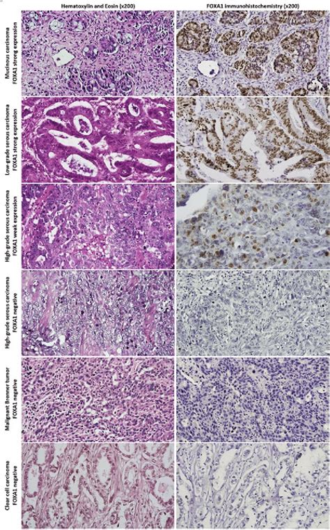 Representative examples of epithelial ovarian cancers (EOC) of ...