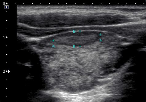 A few observations on thyroid ultrasound - Dr Iain Duncan