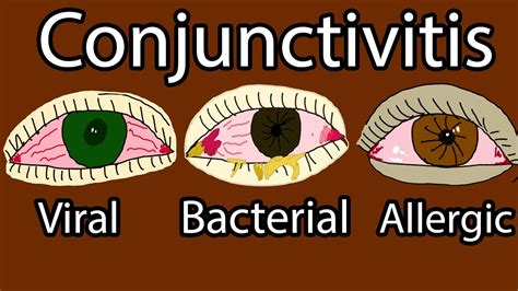 Pink Eye - Conjunctivitis: What Is, Types, Symptoms, How to Treat, and ...