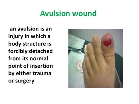 Wound care and treatment for nursing