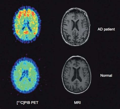 Positron Emission Tomography (PET) - Shining a light on human disease ...