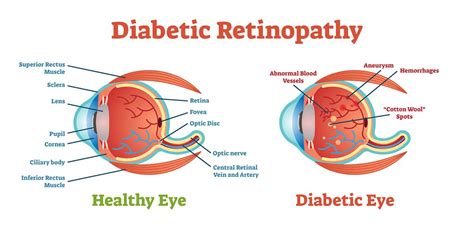 Diabetic Retinopathy: Diagnosis and Treatments - Asia Retina Singapore