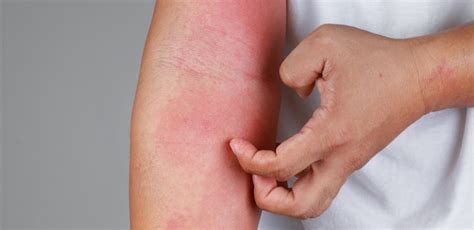 Scabies vs. Eczema: Know The Difference to Help Treat Your Skin