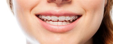 Six Month Smiles | Redcliffe Dental Practice