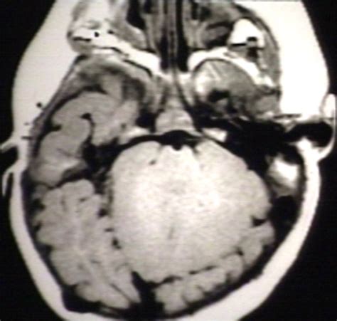 Arnold-Chiari malformation MRI - wikidoc