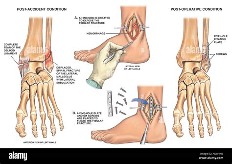 Lateral malleolus fracture hi-res stock photography and images - Alamy