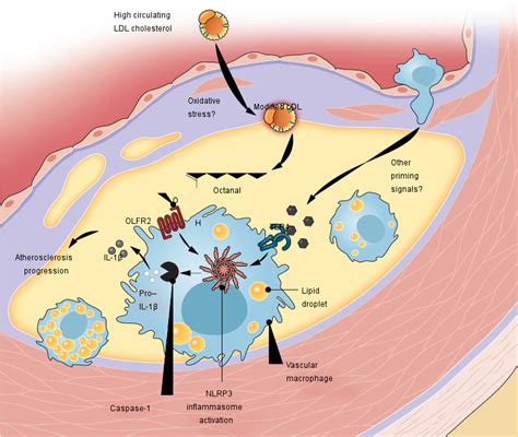 Atherosclerosis Diagram