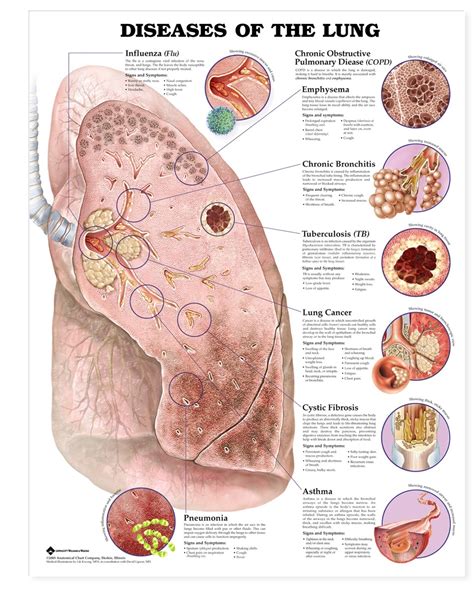 Diseases of the Lung Chart - MedWest Medical Supplies