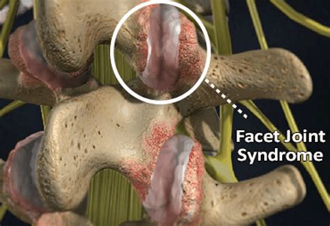 Facet Syndrome - Facet Disease | Causes, Symptoms & Treatment