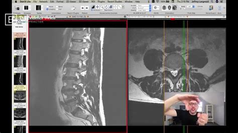 What does a pinched nerve look like on MRI? | What does a pinched nerve ...