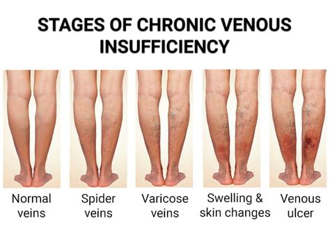 Causes Of Venous Stasis Dermatitis