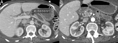 (A) CT pancreatic protocol showed a severely atrophic pancreas with a ...