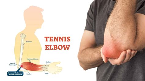 10 Early Symptoms of Tennis Elbow Most People Ignore