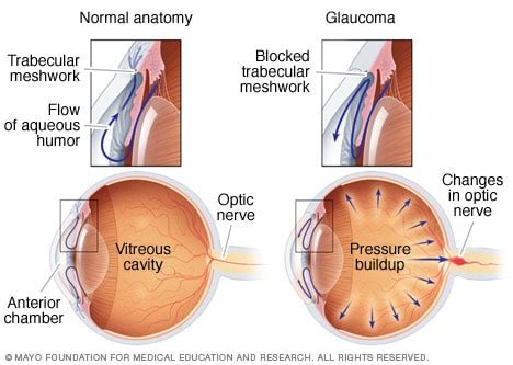 Glaucoma - Symptoms and causes - Mayo Clinic