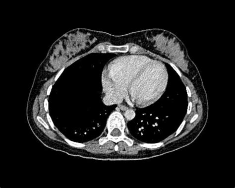 CT Lung Cancer Screening – Issues to Consider