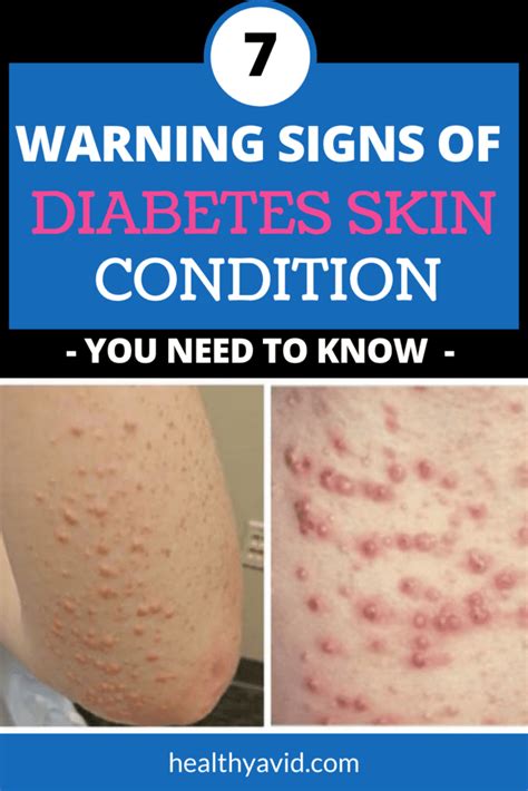 7 Diabetes Skin Problems and Warning Signs You Should Know