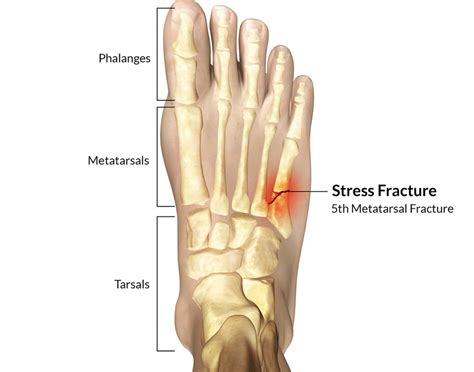 stress fracture - Runner's Tribe