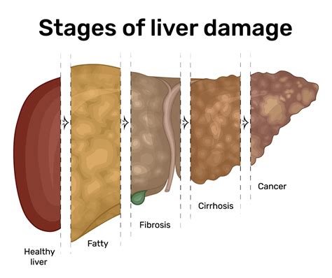 Liver Disease | Aurora Health Care